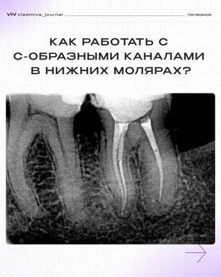 С-образные каналы: алгоритм работы с КЛКТ и биокерамикой.